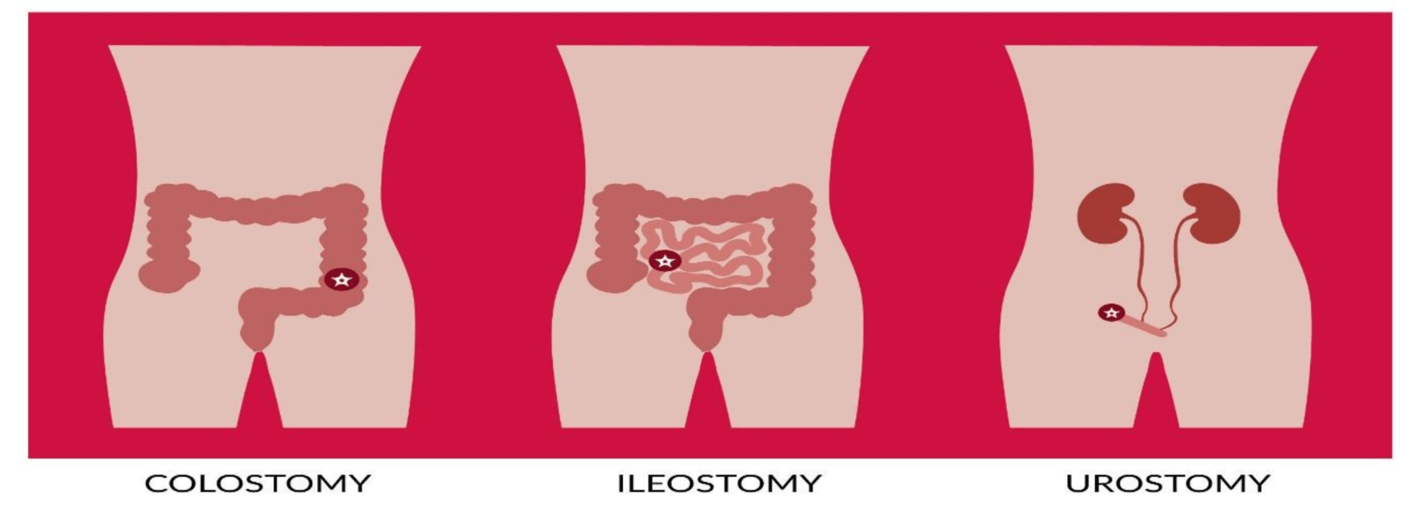 Understanding Having an Ostomy and Its Impact on Daily Life